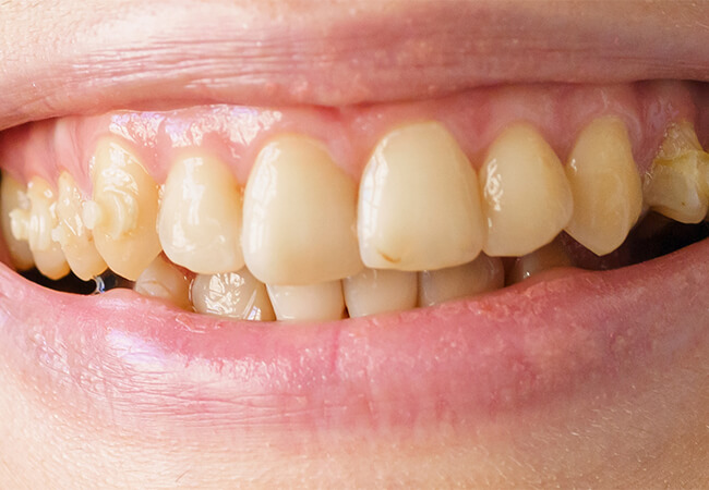 Teeth Before Bleaching