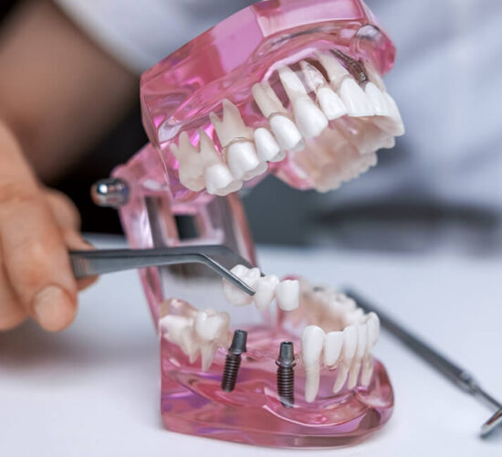 Dental Bridges