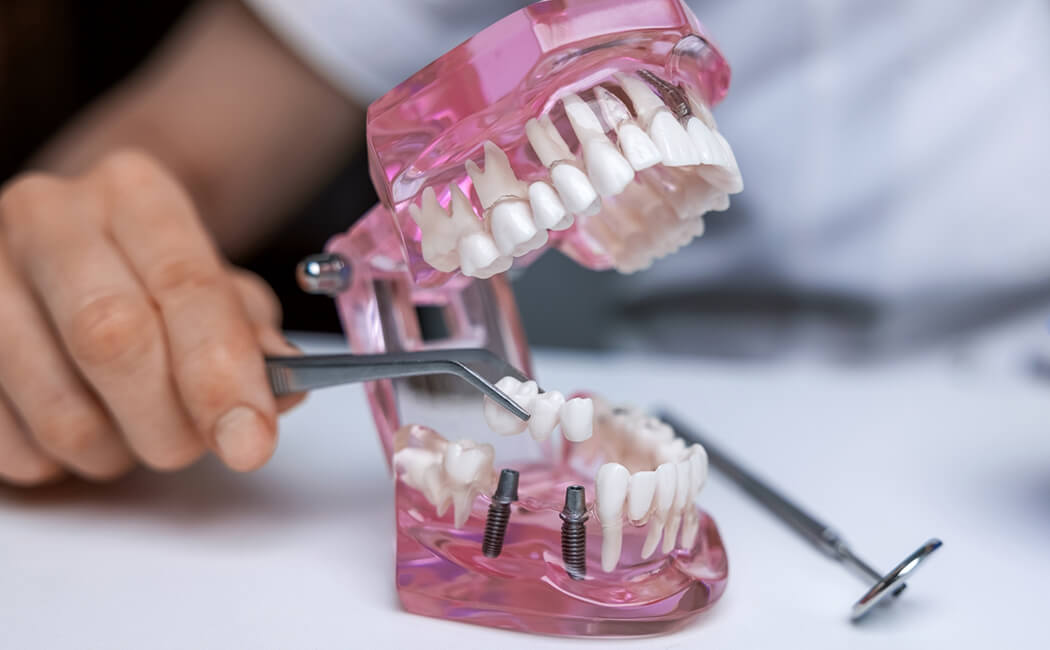 Dental Bridges in Turkey