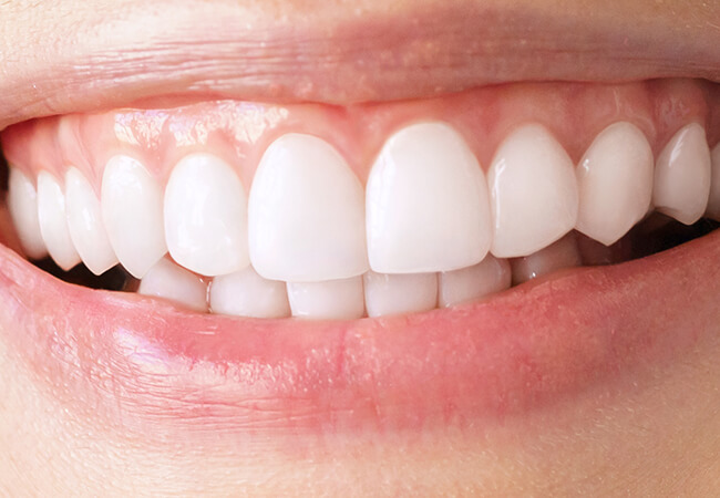 Teeth After Bleaching