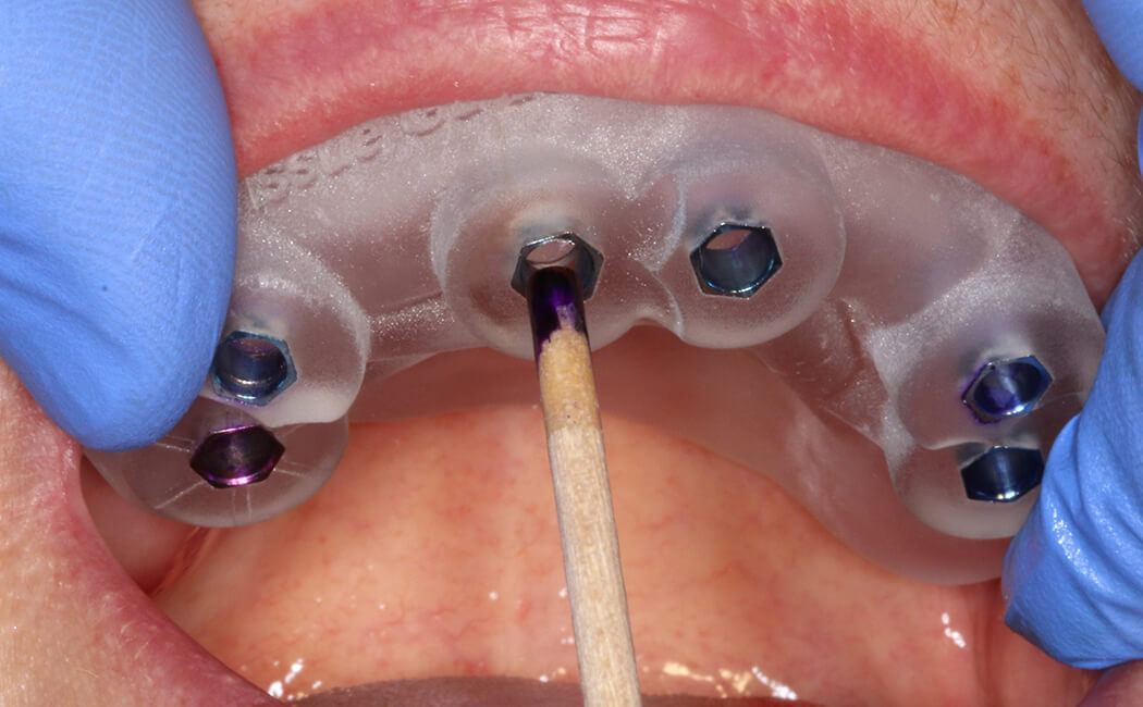 All On Six Dental Implants in Istanbul